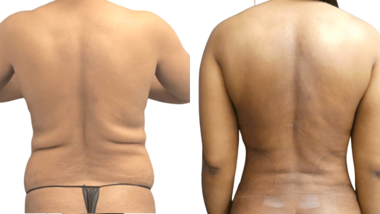 mummy makeover before and after case 1 view 2