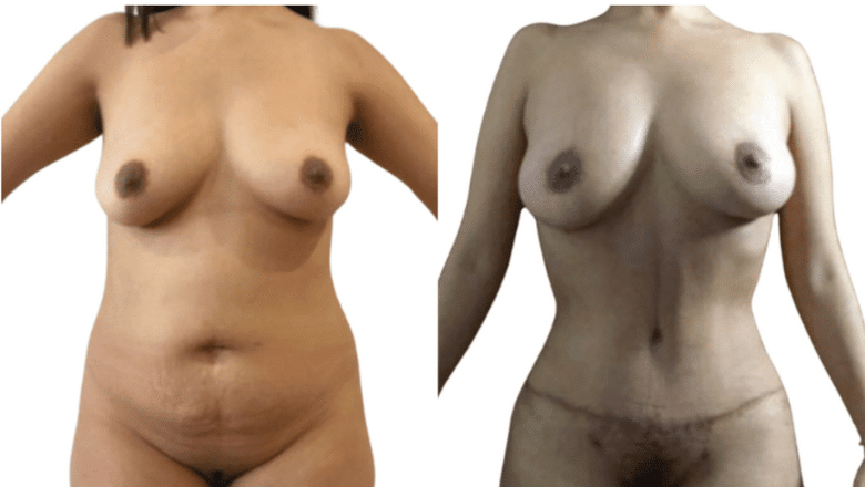 mummy makeover before and after case 3 view 2