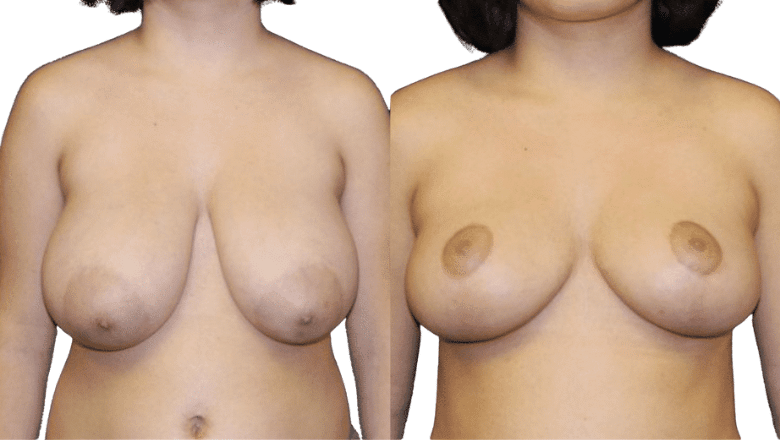 mummy makeover before and after case 4