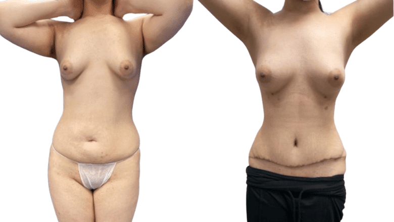 mummy makeover before and after case 5