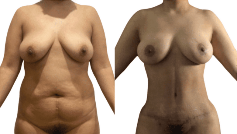 mummy makeover before and after case 5 view 3