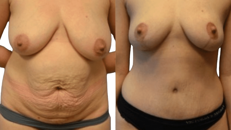 mummy makeover before and after case 6 view 2