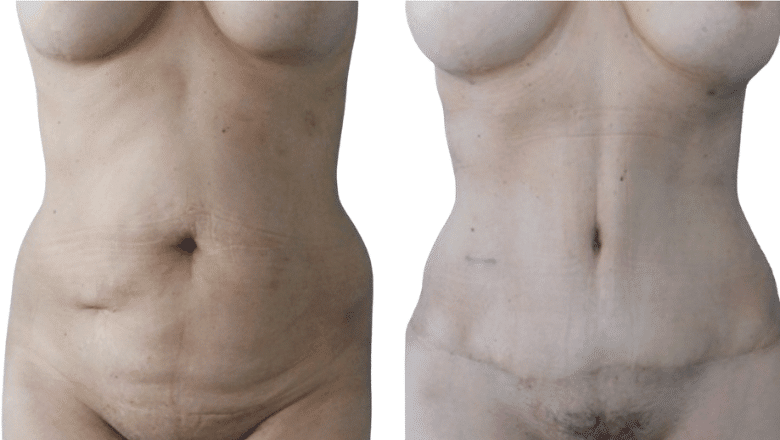 tummy tuck mummy makeover case 7 view 3