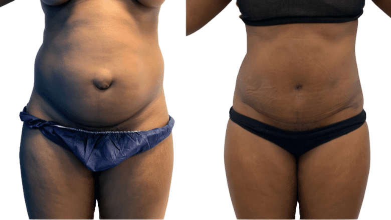 tummy tuck muscle repair mummy makeover case 7 view 2