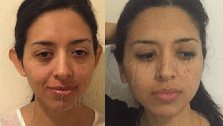 otoplasty before and after case 5 front view