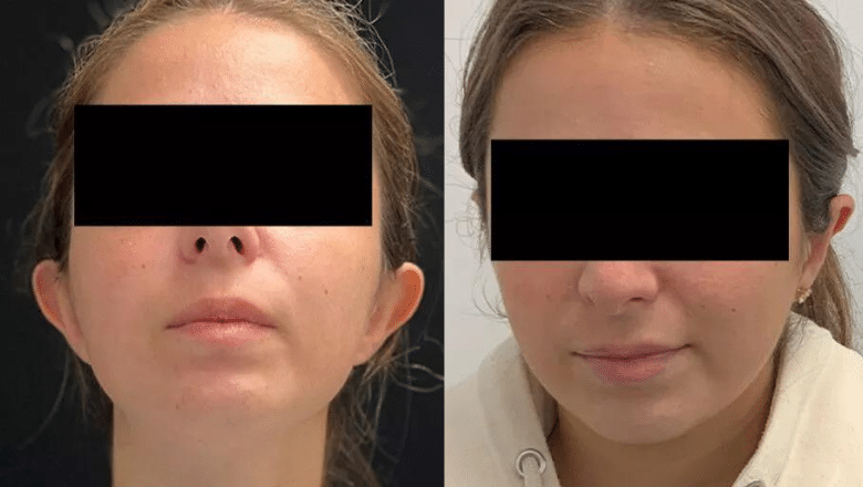 otoplasty before and after case 6 view 1