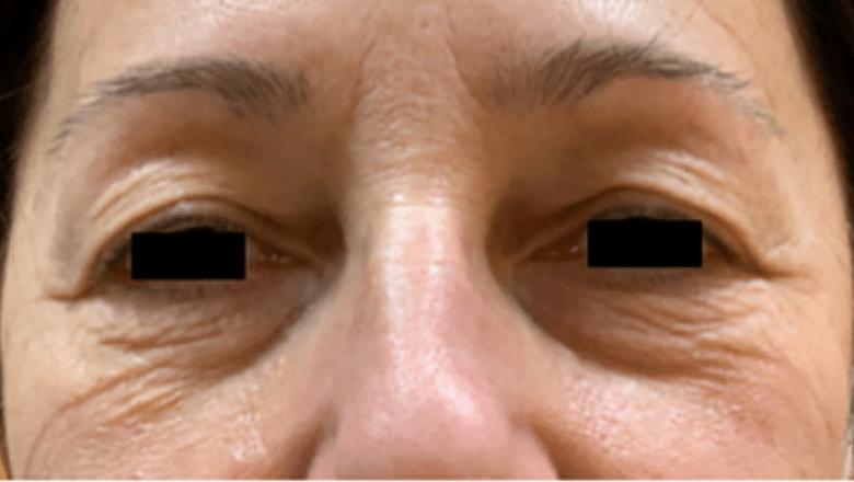 blepharoplasty before photo case 6