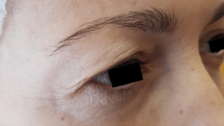 upper eyelid surgery side view before case 7