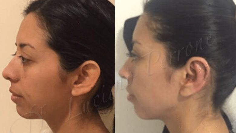 otoplasty before and after case 5 rear view
