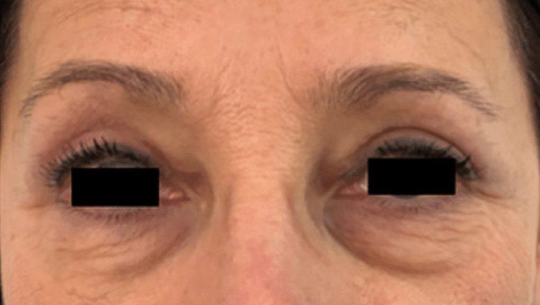 blepharoplasty after photo case 6