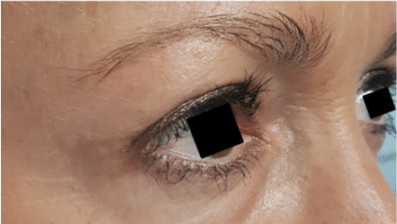upper eyelid surgery side view after case 7