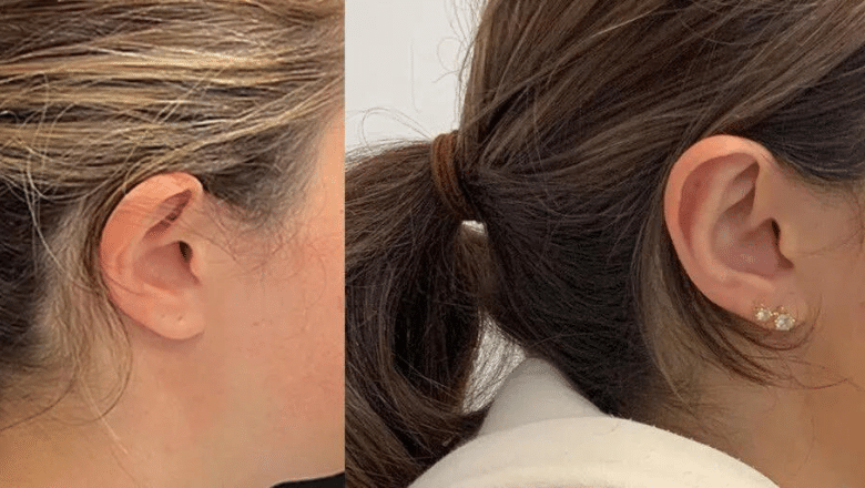 otoplasty before and after case 6 view 3