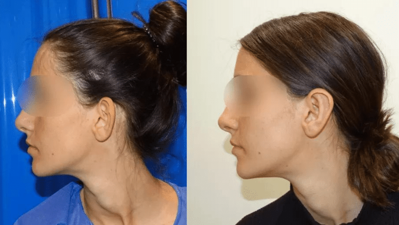 otoplasty before and after case 1 side view
