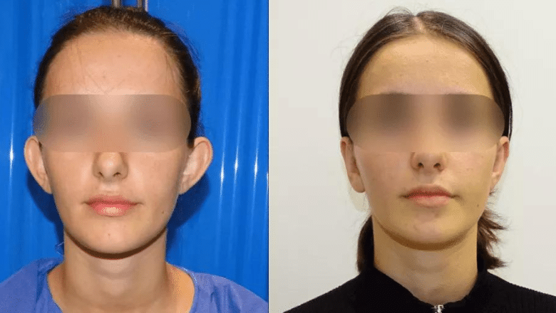 otoplasty ear pinning before and after case 1