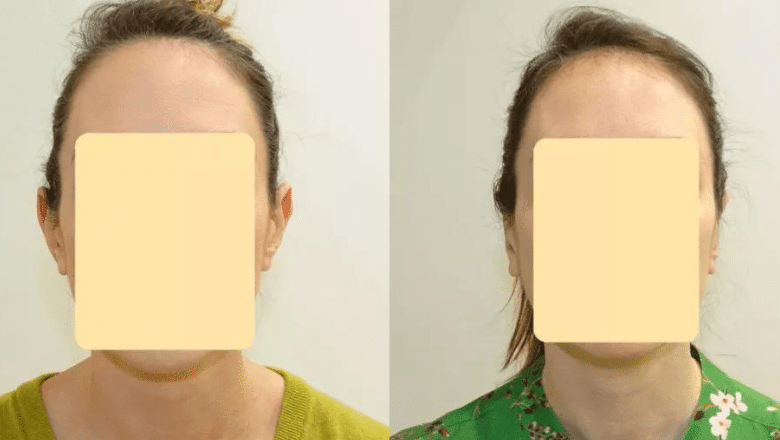 otoplasty surgery before and after case 3