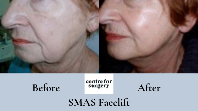 SMAS facelift before and after