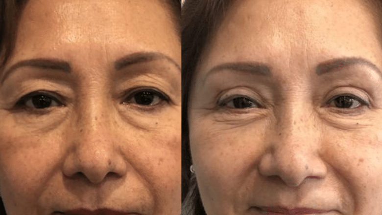 Upper eyelid surgery before and after