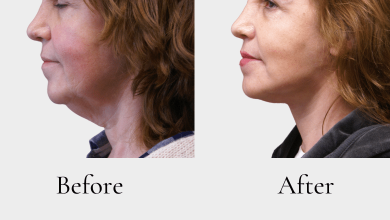 facelift and neck lift combined before and after