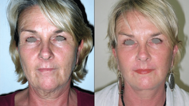 facelift before and after