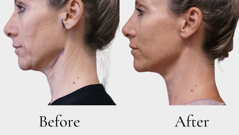 neck lift before and after side view