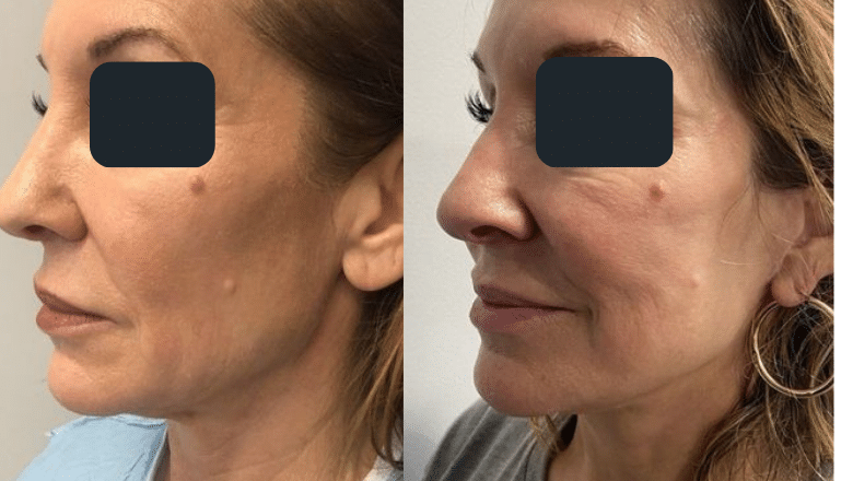mini facelift before and after result