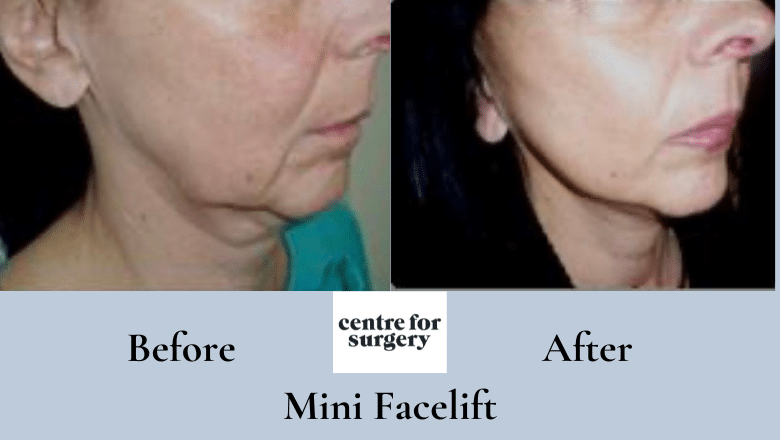 mini facelift before and after