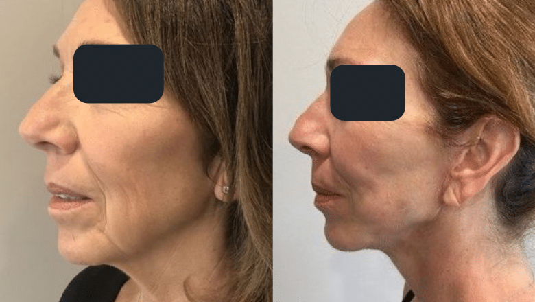 mini facelift surgery before and after side view