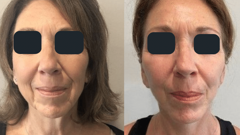 mini facelift surgery before and after