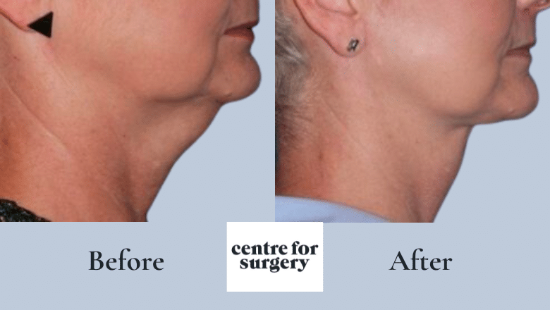 neck lift before and after case 1
