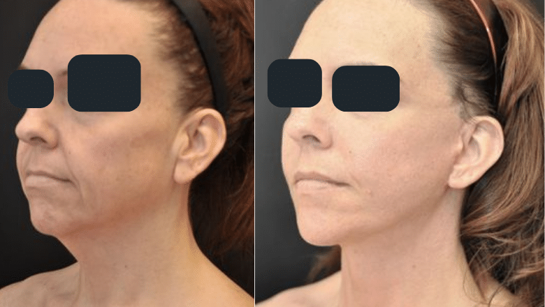 neck lift surgery before and after side view