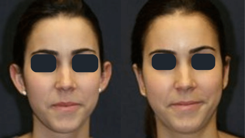 otoplasty ear pinning before and after case 2