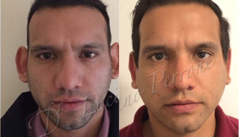 otoplasty ear reshaping before and after case 4