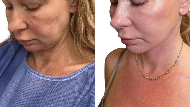 Facelift Results UK