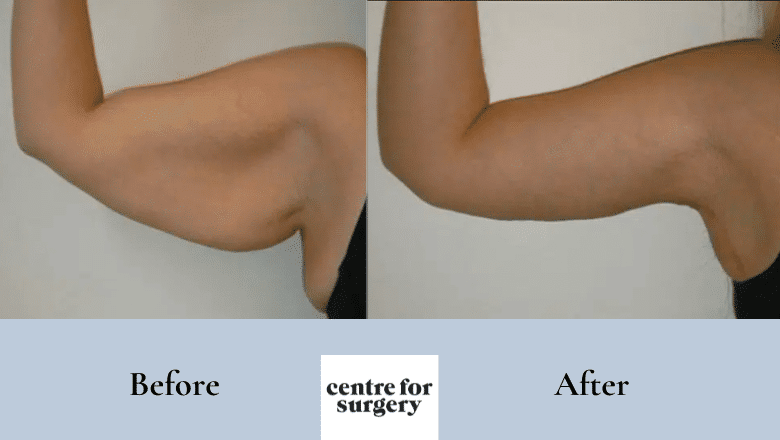 brachioplasty arm lift before after