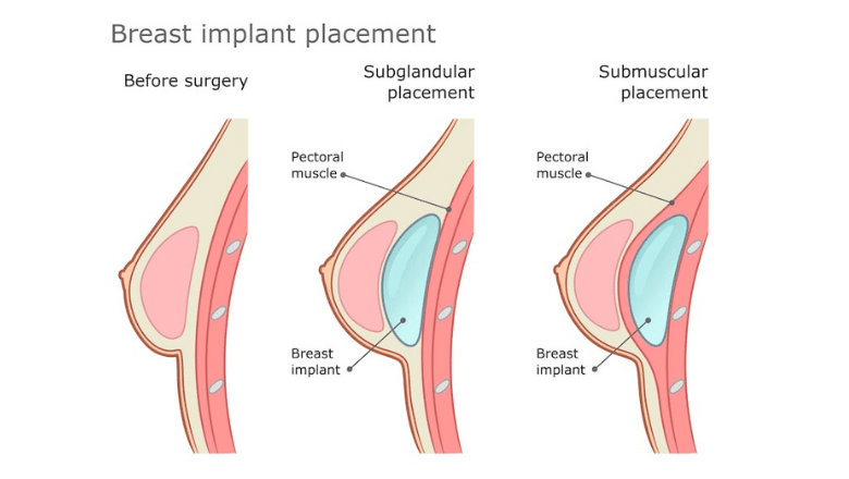 breast-implants-and-breastfeeding-implant-placement