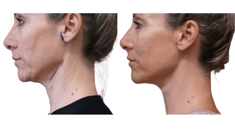 Facelift & Necklift Before and After Side by Side