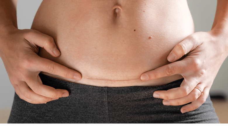 Scar management after cosmetic surgery at Centre for Surgery London