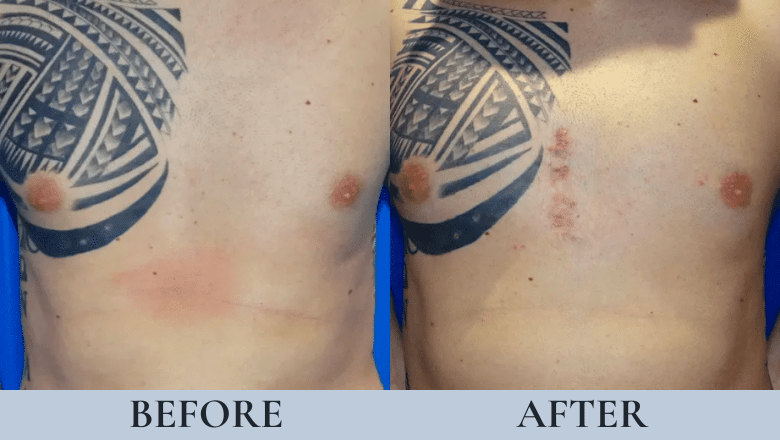 male pectoral implants before and after case 1
