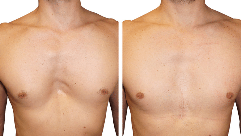 pectus implant before and after case 2