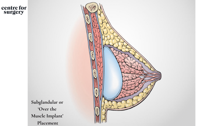Subglandular or ‘Over the Muscle Implant’ Placement