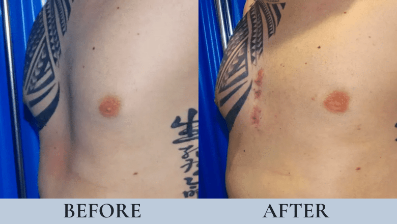 male pectoral implants before and after case 1 view 2