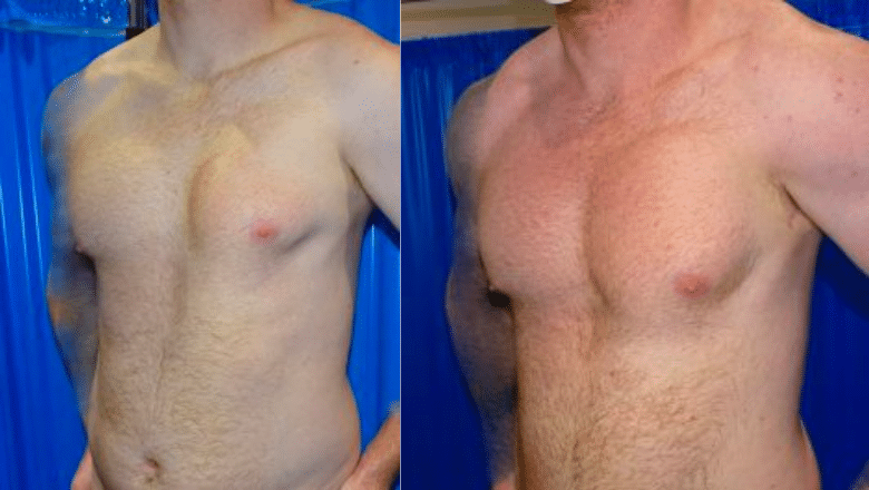 Poland syndrome custom implant case 3 view 2