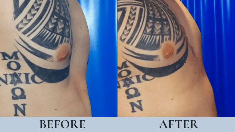 male pectoral implants before and after case 1 view 3