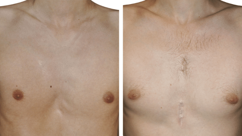 pectus implants before and after case 2 view 3