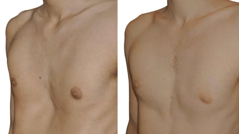 pectus custom implants case 2 view 4