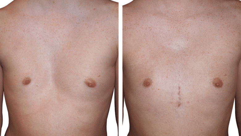 pectus implants results case 2 view 5