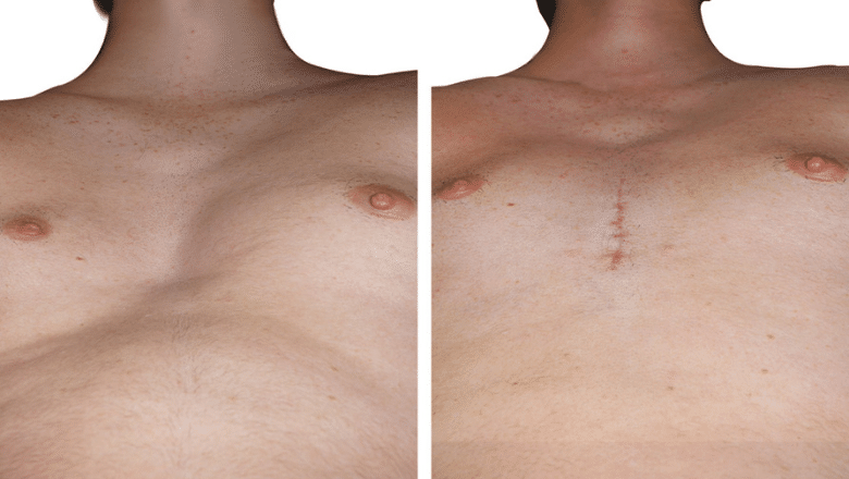 pectus excavatum implants results case 2 view 6
