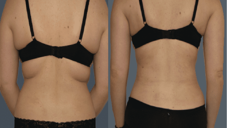 back lipo