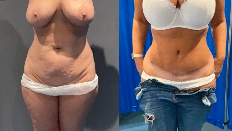 Tummy tuck before and after
