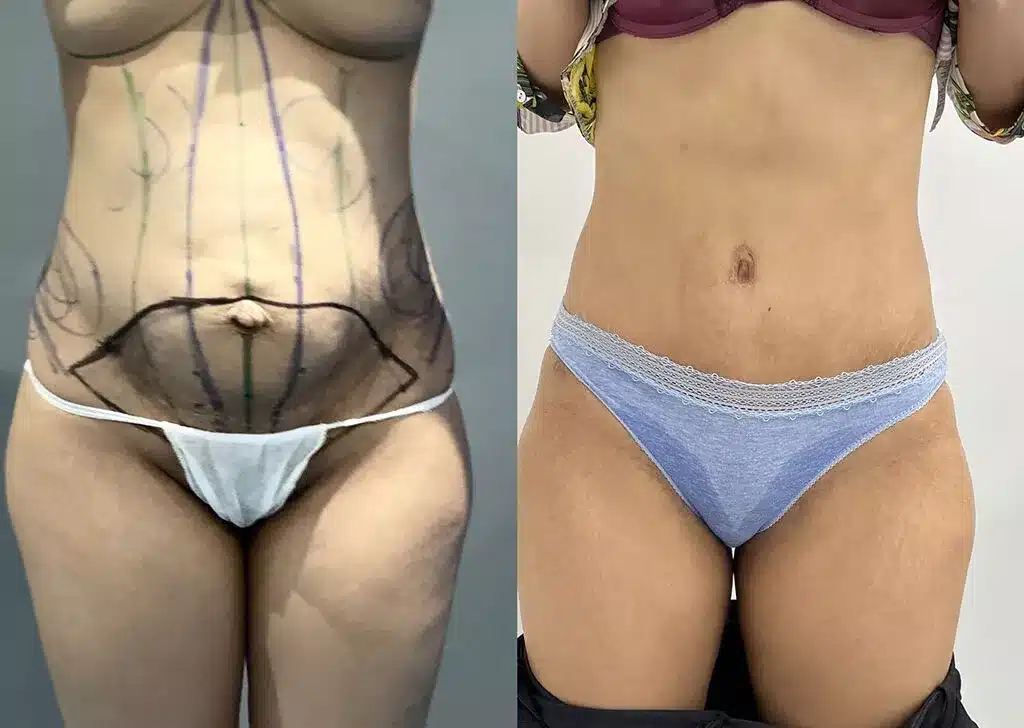 full abdominoplasty